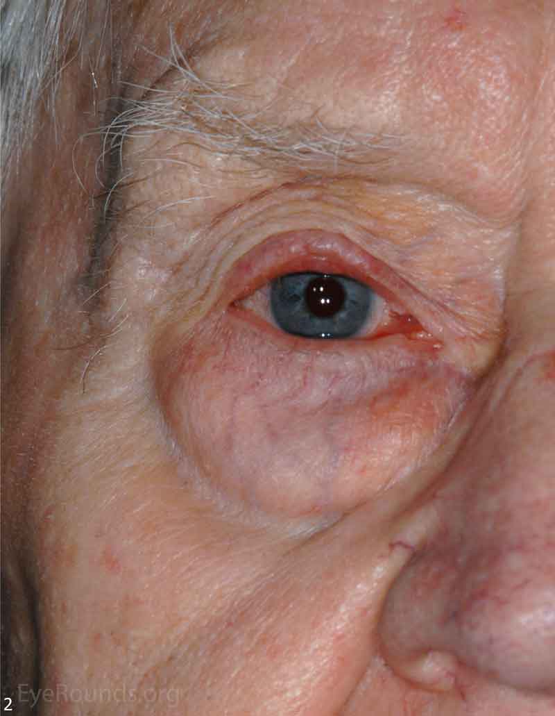 Sebaceous Carcinoma