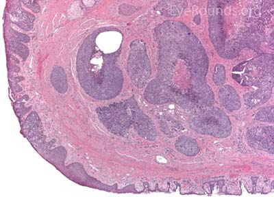  Sebaceous Gland Carcinoma 