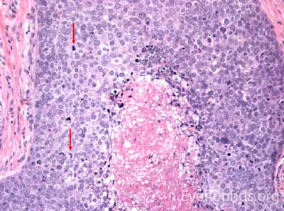  Sebaceous Gland Carcinoma 