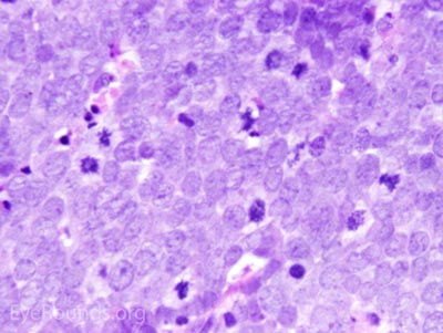 Merkel Cell Carcinoma Histology