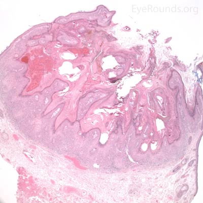 H&E Keratoacanthoma Histology