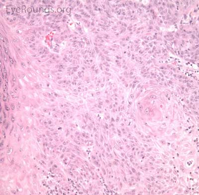 H&E H&E Keratoacanthoma Histology highest mag