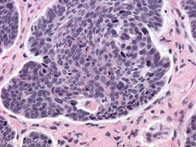  Palisading of the cells around the outer edge of the tumor  