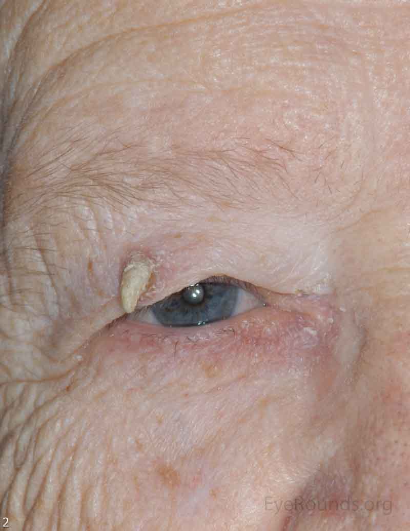 Actinic Keratosis  