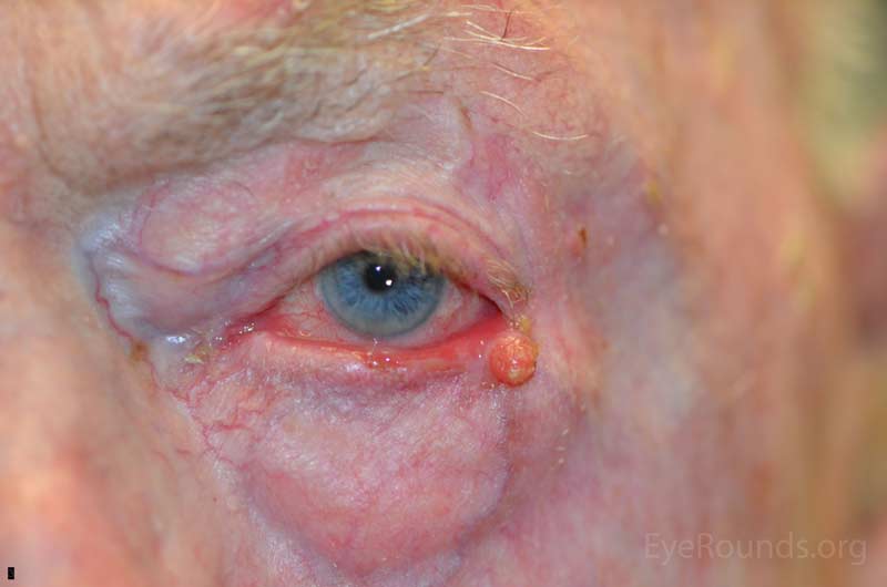 Pedunculated squamous cell carcinoma