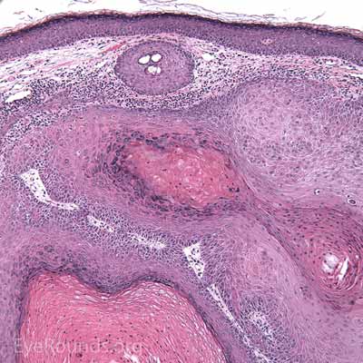 Squamous Cell Carcinoma Histology 