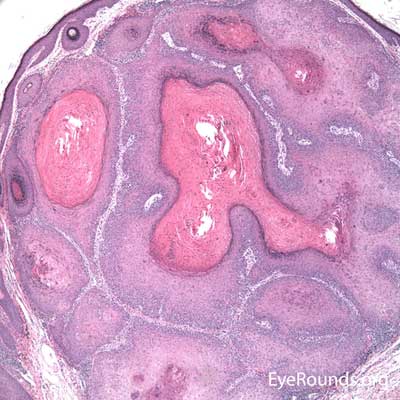 Squamous Cell Carcinoma Histology 