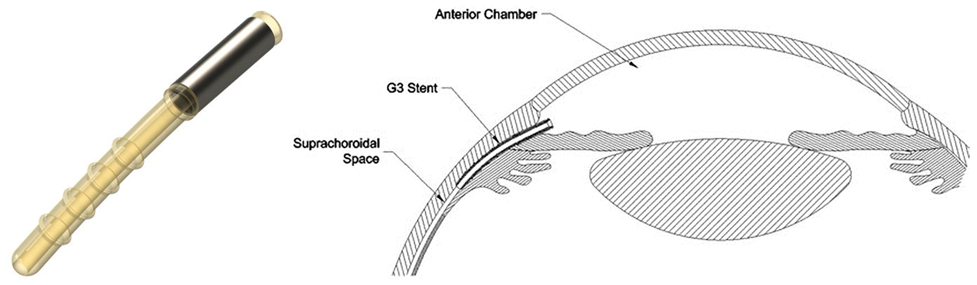 Figure 10. A) iStent SUPRA device. B) iStent SUPRA inserted into suprachoroidal space. Source: Surgical Innovations in Glaucoma. Springer[26]  Images used with permission from Springer-Verlag, New York