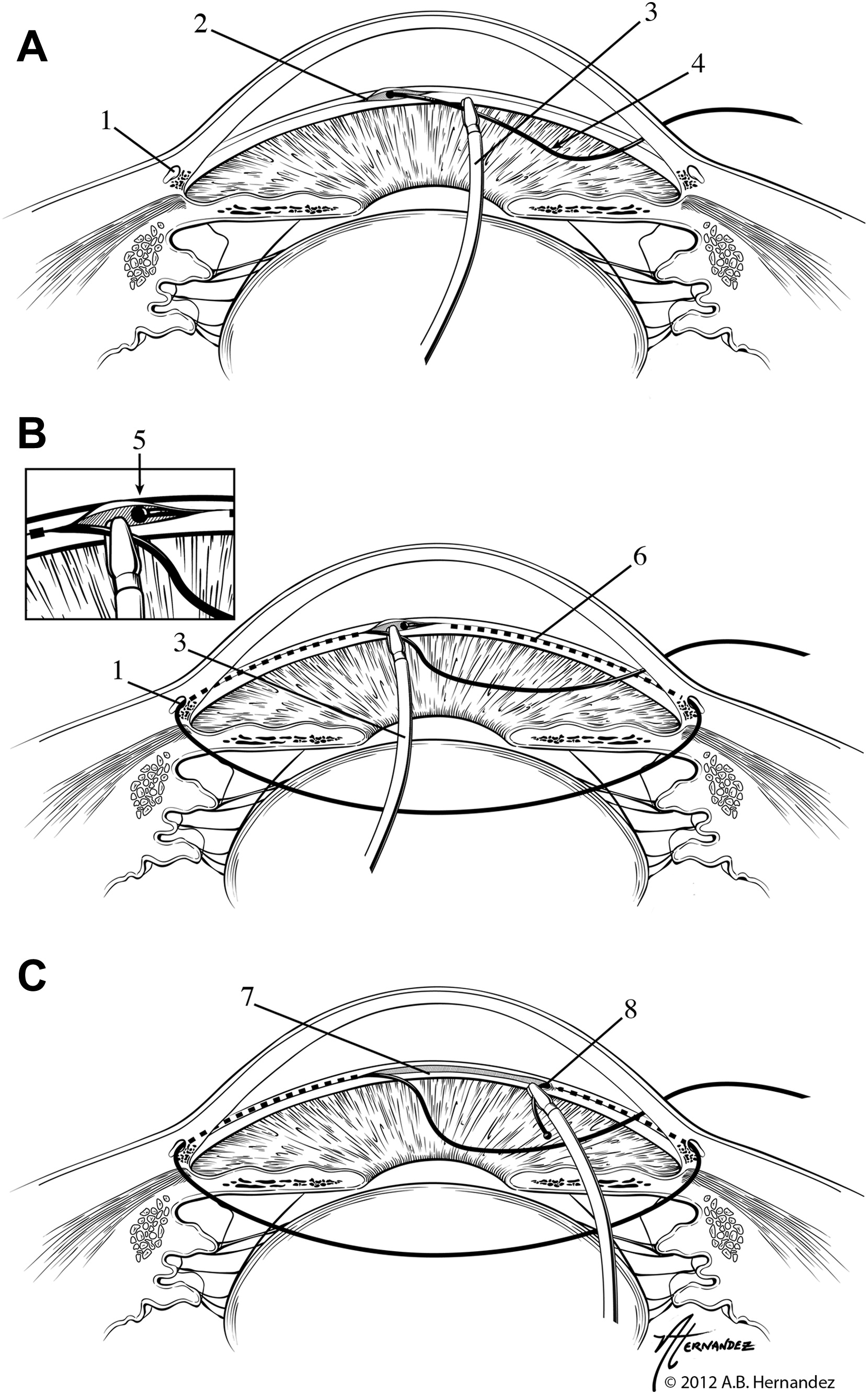 Gonioscopy Assisted Transluminal Trabeculectomy (GATT)