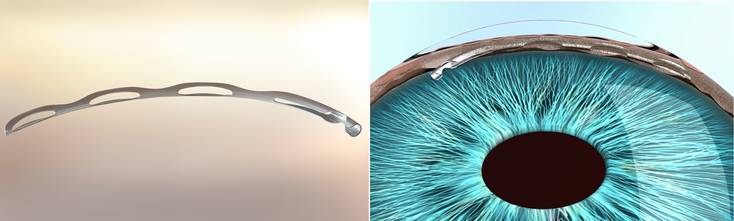 Figure 8. Hydrus Microstent Device. Source: Ivantis, Inc. Images used with permission.