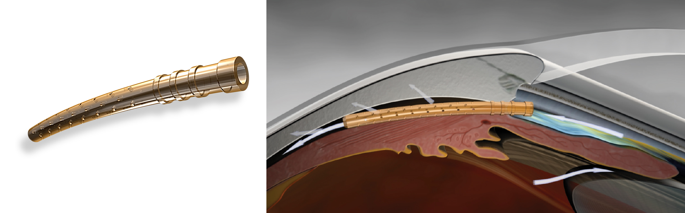 Figure 8. A) CyPass Micro-stent device. B) CyPass Micro-stent device inserted into suprachoroidal space. Source: Alcon. Images used with permission