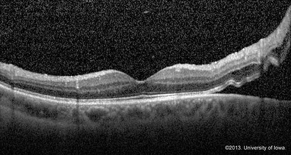 Optical coherence tomography image demonstrating a neurosensory retinal detachment with foveal sparing 