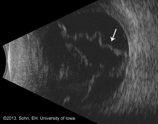 Optical coherence tomography image demonstrating a neurosensory retinal detachment with foveal sparing 