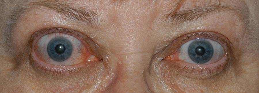 periorbital edema, eyelid retraction, scleral show, and conjunctival injection