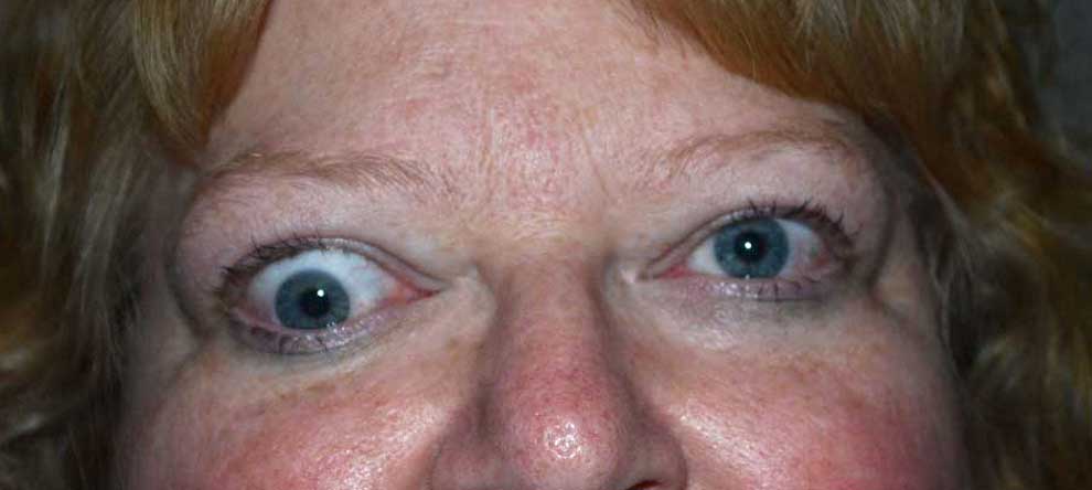 Hypotropia. Note the vertical misalignment of the eyes in primary gaze and the restrictive movement in upward gaze. This is due to an enlarged and restricted inferior rectus muscle.