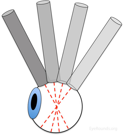 diagram Limbus-to-fornix rotational motion 